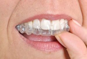 clearaligners